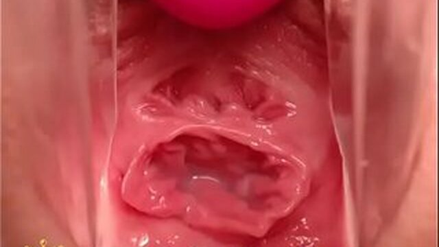 Gynecology camera close-up Vagina Cervix my chat siswet